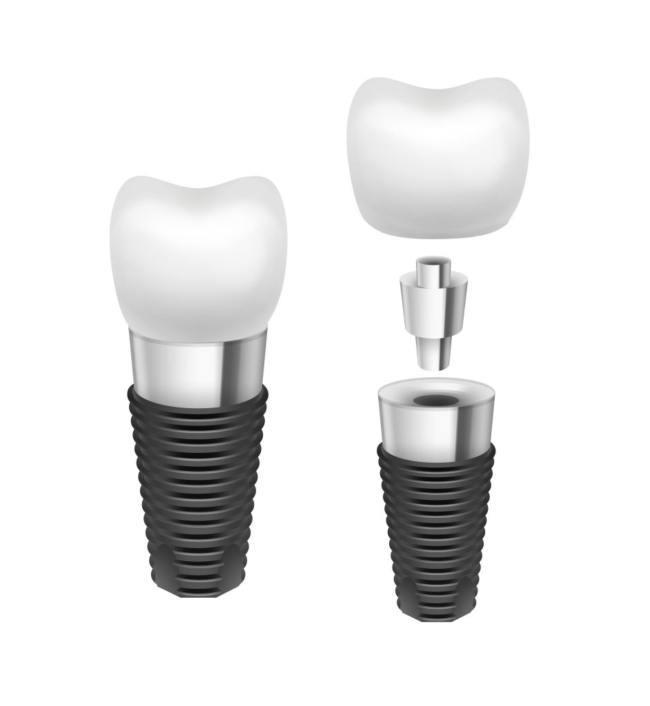 Dental Implants in Strathfield | U Plus Dental