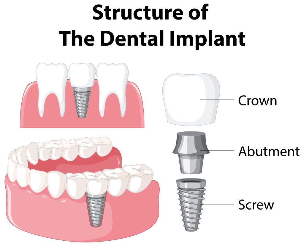 Dental Implants in Strathfield